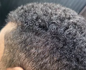 protese capilar masculina de cabelos crespos em brasilia